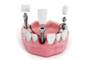 implantes dentales sant cugat