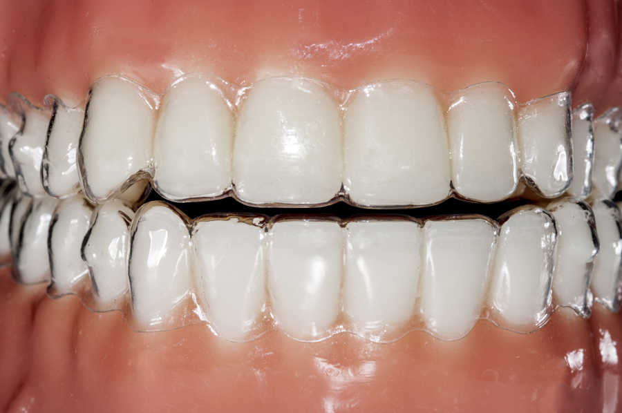 Qué es y Cómo funciona la ortodoncia invisalign?